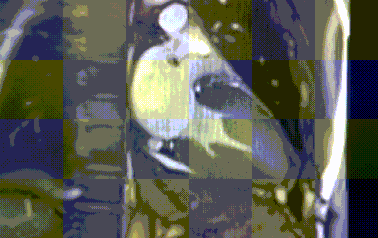 心脏电影序列1.gif
