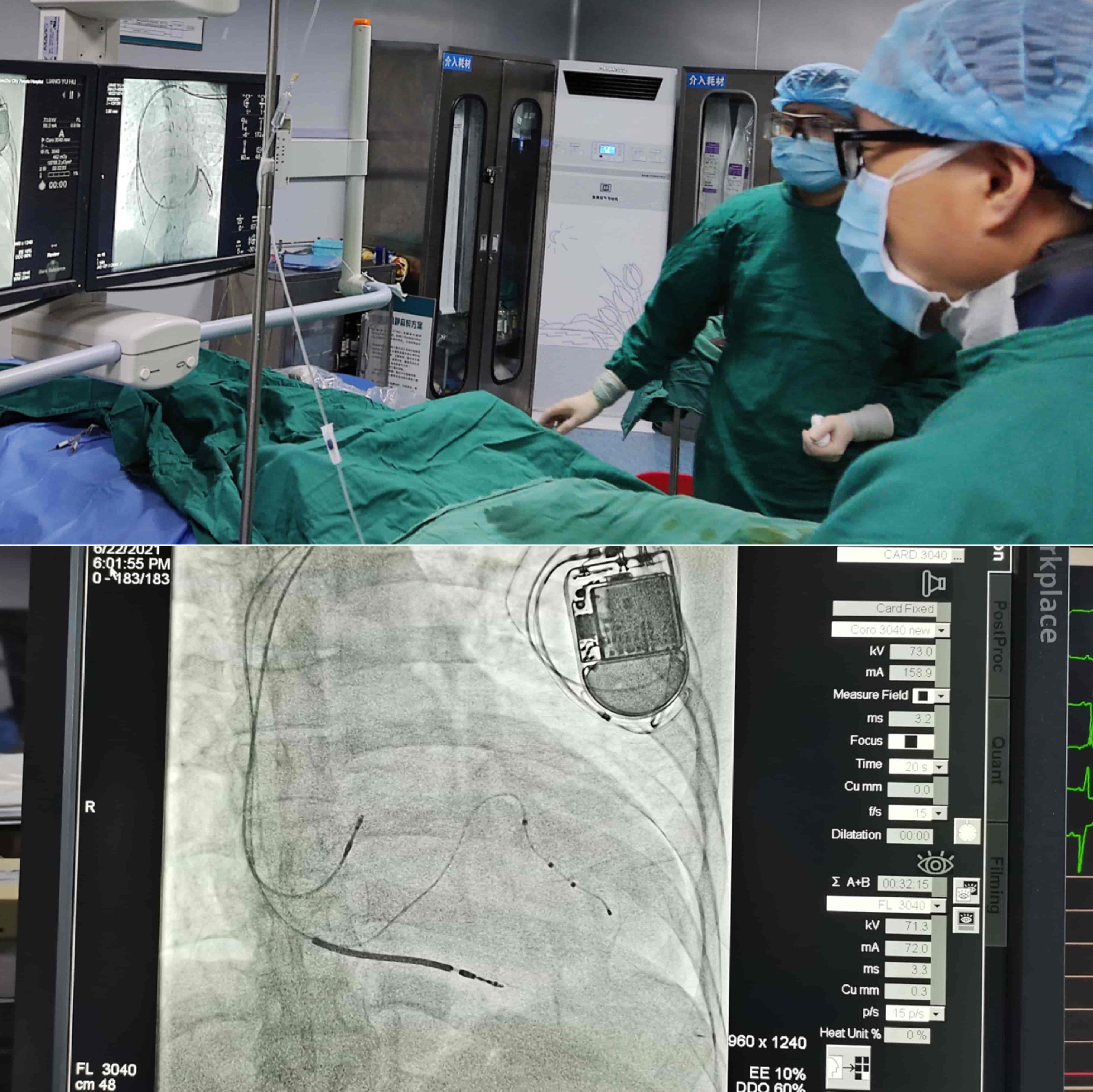 绵竹市人民医院：心内科成功开展首例心脏再同步起搏及自动除颤器植入术.jpg