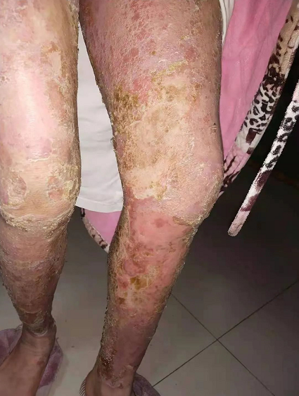 长年以来一直被皮肤瘙痒(严重时甚至流脓渗水,全身严重脱皮所折磨
